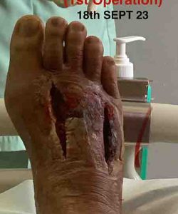 1st Operation (18 Sep 2023) | En Wan Testimonial