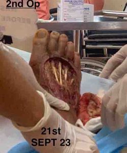 2nd Operation (21 Sep 2023) | En Wan Testimonial